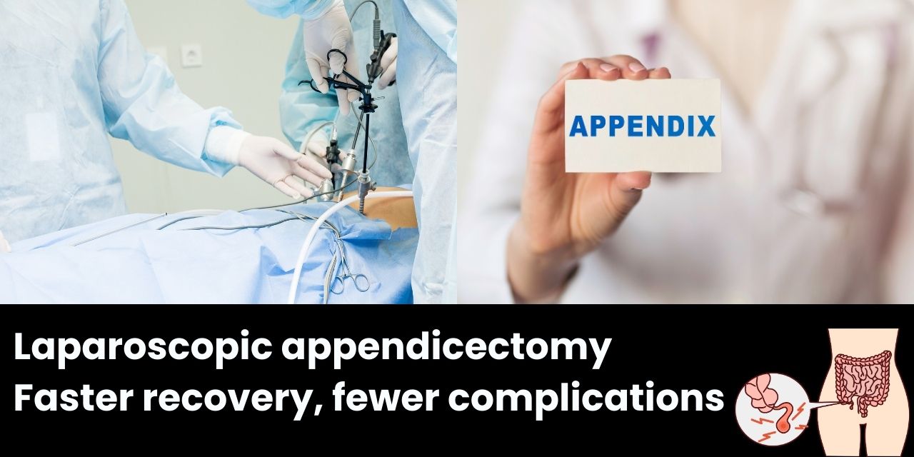 Laparoscopic Appendicectomy: The Preferred Method for Treating Appendicitis