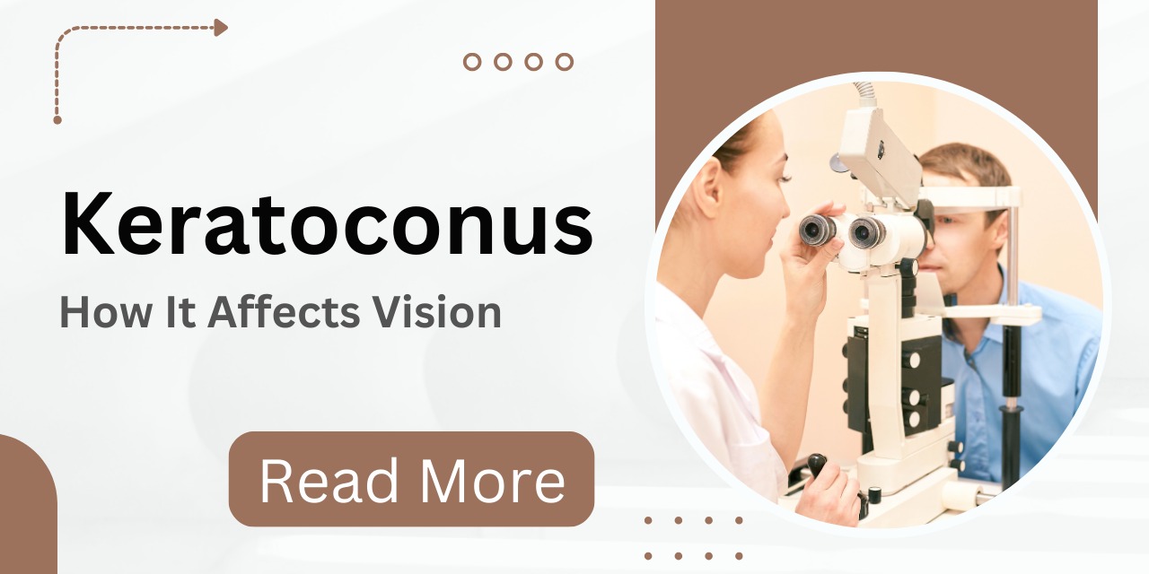 Keratoconus Eye Disease: Understanding the Impact on Your Vision